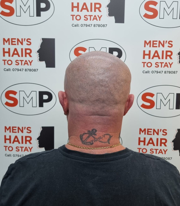 🥇 West Palm Beach Tattoo Removal | Wellington Dermatologist Laser Near Me